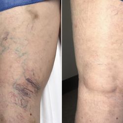 Siragusa Vein and Laser