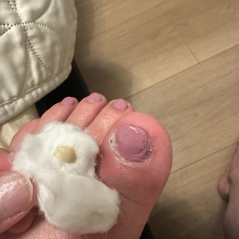 2k Nails - Puss right after 2nd day of suffering and in pain after regular pedi. - Nail Salons Near Me - Mission Hills, California