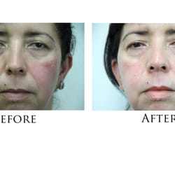 7e Fit Spa - Micro current after 6 treatments