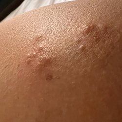 Holiday Inn Express & Suites Ooltewah Springs-Chattanooga - Multiple bed bug bites. Typically they bite in rows of three or clusters.