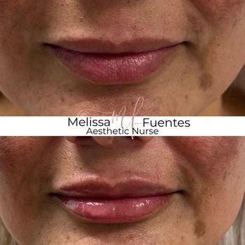 Toxxy Aesthetics & Laser - Lip filler - Aestheticians Near Me - Redlands, California Toxxy Aesthetics & Laser - Lip filler - Aestheticians Near Me - Redlands, California