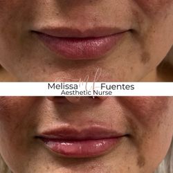 Toxxy Aesthetics & Laser - Lip filler