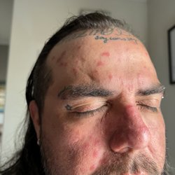 MedPost Urgent Care of New Braunfels - Face was more swollen and rash has raised even more