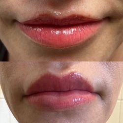 Beauty Unleashed MedSpa - I full syringe of Versa & lip flip with botox