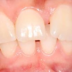 Hillary Kim, DMD & Raymond Kwok, DMD - Six Month Smiles Before