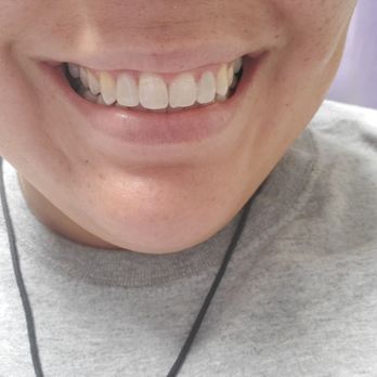 Michelsen Dental - After/ mock up only. Finish work coming soon. - General Dentistry Near Me - Orange, California Michelsen Dental - After/ mock up only. Finish work coming soon. - General Dentistry Near Me - Orange, California