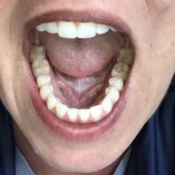 Jeremy Heldt, DDS - Shiny new molars. =) - General Dentistry Near Me - Newport Beach, California Jeremy Heldt, DDS - Shiny new molars. =) - General Dentistry Near Me - Newport Beach, California