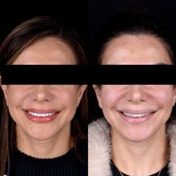 Modern Smiles - Beautiful smile transformation with veneers, correcting size, color and shape by Dr. Kasra Tajik