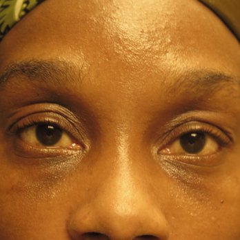 Lorri Cobbins, MD - Before with flash - Cosmetic Surgeons Near Me - Chicago, Illinois