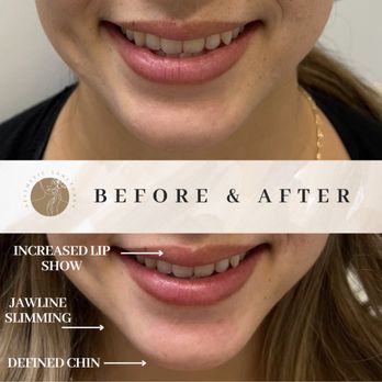 Aesthetic Sanctuary - Only one week after a lip flip and masseter tox for clenching and jawline slimming. *Results may take 2-4 weeks for full effect.* - Medical Spas Near Me - Honolulu, Hawaii Aesthetic Sanctuary - Only one week after a lip flip and masseter tox for clenching and jawline slimming. *Results may take 2-4 weeks for full effect.* - Medical Spas Near Me - Honolulu, Hawaii