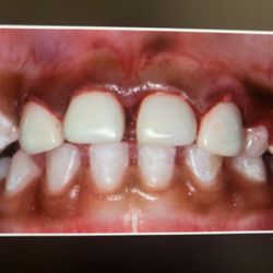 Knox Pediatric Dentistry - Our pediatric dentist will be able to do white crowns for front baby teeth