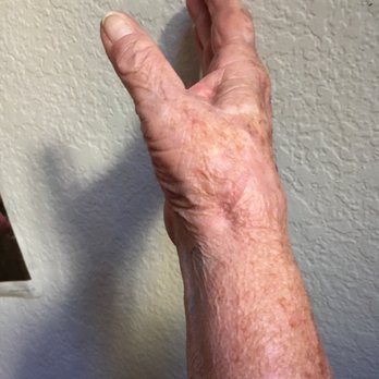 Stefan Klein, MD - Dimple at base of thumb is where a nickel sized hole that popped a piece of hardware into the air! - Orthopedists Near Me - Santa Cruz, California Stefan Klein, MD - Dimple at base of thumb is where a nickel sized hole that popped a piece of hardware into the air! - Orthopedists Near Me - Santa Cruz, California