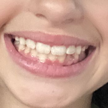 Haney Orthodontics - Final result - 13 months later. - Orthodontists Near Me - San Anselmo, California Haney Orthodontics - Final result - 13 months later. - Orthodontists Near Me - San Anselmo, California