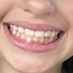 Haney Orthodontics - Final result - 13 months later.