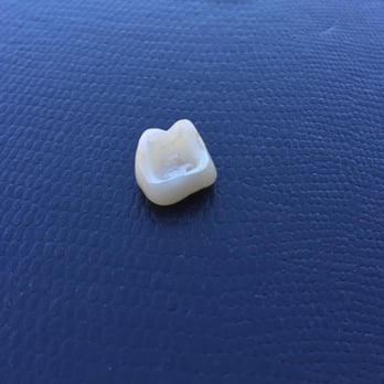 Stacy Godes, DDS - Great work Dr. Godes, isn't the tooth supposed to stay in the mouth? - Cosmetic Dentists Near Me - Solana Beach, California