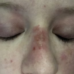 Day 3 (I had just woken up from sleeping on the right side of my face, which is why my right cheek is so rosy in this picture). Day 3 (I had just woken up from sleeping on the right side of my face, which is why my right cheek is so rosy in this picture).