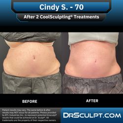 Dr. Sculpt CoolSculpting & EmSculpt Center - After 2 CoolSculpting treatments on abdomen/flanks