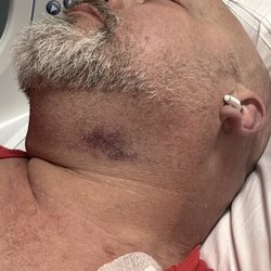 Just bigger picture of bruising and swelling