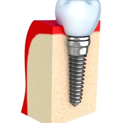 Mark J Gleckner, DMD - Implant Dentistry