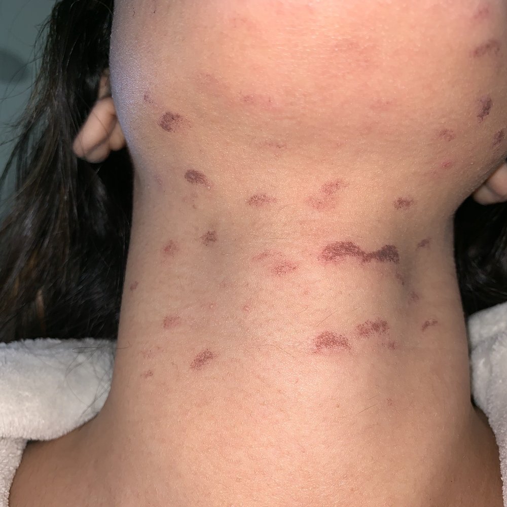 Ideal Image Langhorne - A SCAM! Laser Hair Removal did not work and left me with burns. This is after I paid a total of $3,577.00 and completed all treatments - Laser Hair Removal Near Me - Langhorne, Pennsylvania