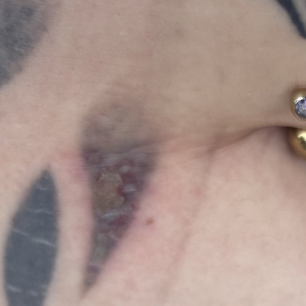 Rock Star Beauty Lounge - Burn from tattoo removal - Hair Salons Near Me - Thornton, Colorado Rock Star Beauty Lounge - Burn from tattoo removal - Hair Salons Near Me - Thornton, Colorado