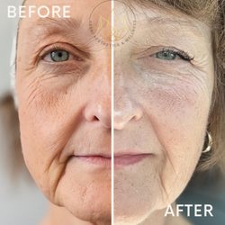 Abeni Aesthetics & Wellness  - Skin renewal- NOUVADerm targets fine lines, wrinkles, and texture. 13 days after treatment. Results will continue over the next few weeks.