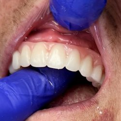 Bickford Family Dental Care - Entire front gum carved away to fit