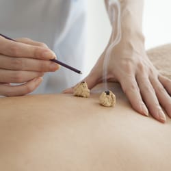 Midtown East Acupuncture - Moxibustion