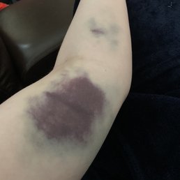 Left arm after donating Left arm after donating