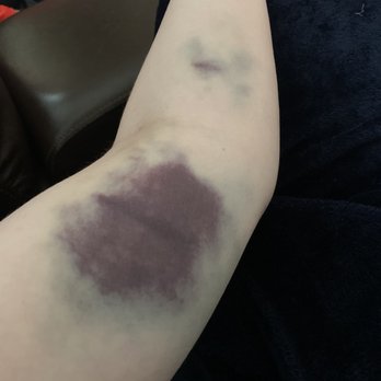 Octapharma Plasma - Left arm after donating - Blood & Plasma Donation Centers Near Me - Plano, Texas Octapharma Plasma - Left arm after donating - Blood & Plasma Donation Centers Near Me - Plano, Texas