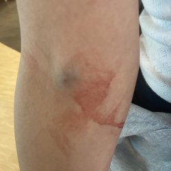 Quest Diagnostics - Poor job with blood draw and horrible attitude