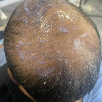 Discover Your Illusions Salon - A client experiencing alopecia getting ready for install - Hair Extensions Near Me - San Leandro, California Discover Your Illusions Salon - A client experiencing alopecia getting ready for install - Hair Extensions Near Me - San Leandro, California