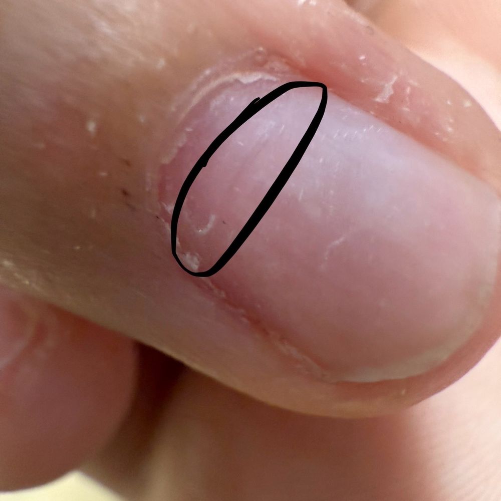Number 1 Nail Spa - Since the nail drill speed was so high, there is this really deep dent inside my nail now. - Nail Salons Near Me - Brooklyn, New York