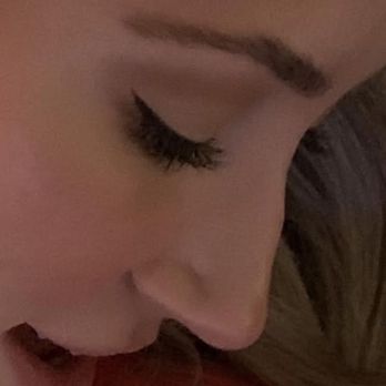 Dino Elyassnia, MD - Before surgery photo - Cosmetic Surgeons Near Me - San Francisco, California
