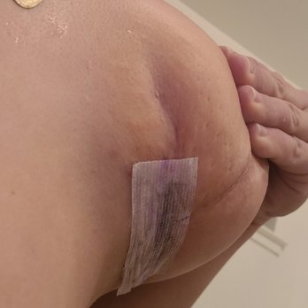 Hongshik Han MD - He caused the area he cut to collapse. It folds over. I now have 2 parts to my breast. Completely hideous! - Cosmetic Surgeons Near Me - Fresno, California