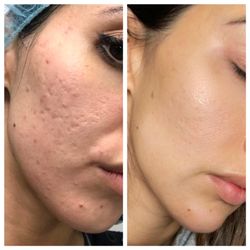 Spa Medica Aesthetic - Microneedling with PRP injections combine with other treatments for acne scars