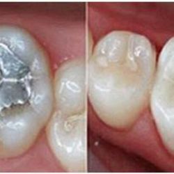Dental Californias - Realizamos cambio de rellenos metálicos por rellenos del color del diente