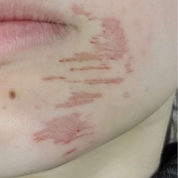 Prachi Threading and Beauty Salon - results from facial waxing. - Skin Care Near Me - Fullerton, California Prachi Threading and Beauty Salon - results from facial waxing. - Skin Care Near Me - Fullerton, California