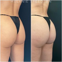 Flawless MedSpa by Melanie Speed - Before and after Flawless Butt Lift by Melanie Speed, RN BSN CANS