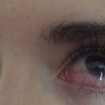 Mink Lash Boutique - Chemical eye burn - Eyelash Service Near Me - Vancouver, British Columbia Mink Lash Boutique - Chemical eye burn - Eyelash Service Near Me - Vancouver, British Columbia