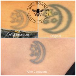Emily Bonney - Progression of saline tattoo removal.