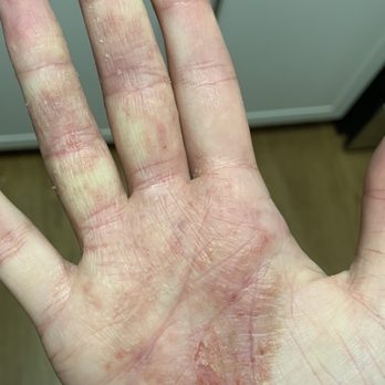 Riverpoint Wellness Group - Before I started acupuncture. Eczema covering majority of palm and fingers. - Acupuncture Near Me - Hoboken, New Jersey
