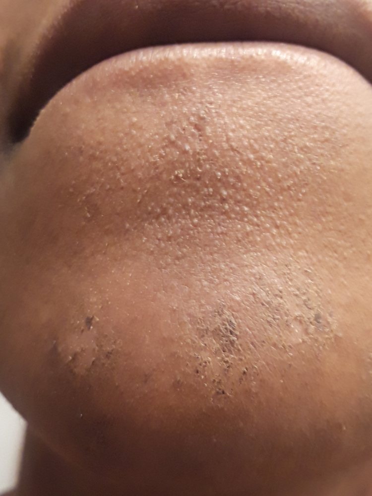 LASER & ELECTROLYSIS 13 Photos 2641 Raeford Rd, Fayetteville, North