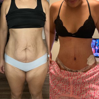 Liposuction Center Moein Surgical Arts - Tummy tuck before and after - Medical Spas Near Me - Los Angeles, California