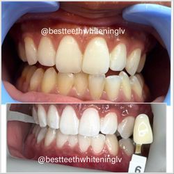 3 20 minute sessions! Dazzling results! From a level 6 to a -1 results vary person to person.