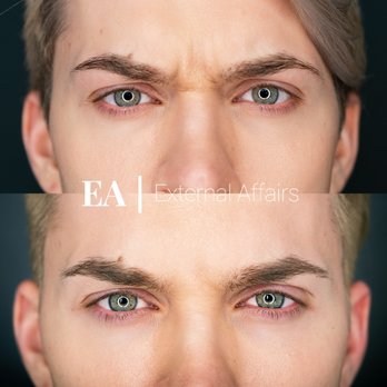 External Affairs - Nothing better than the feeling of your Botox® kicking in! Book here: https://externalaffairs.ca/contact-form/ - Medical Spas Near Me - Edmonton, Alberta External Affairs - Nothing better than the feeling of your Botox® kicking in! Book here: https://externalaffairs.ca/contact-form/ - Medical Spas Near Me - Edmonton, Alberta