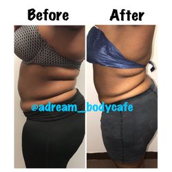 Adream Body Cafe - Results in a few sessions! Book a consultation today to prepare for your body journey!  https://squareup.com/appointments/book/VWDJ15V2H95Q