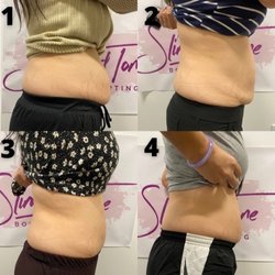 Slim and Tone OC - I saw big changes when I first started until my 4th treatments.