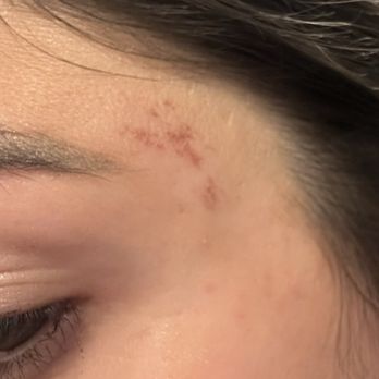 Star Threading & Eyebrow Salon - Burn face - Threading Services Near Me - Brooklyn, New York