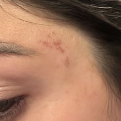 Star Threading & Eyebrow Salon - Burn face